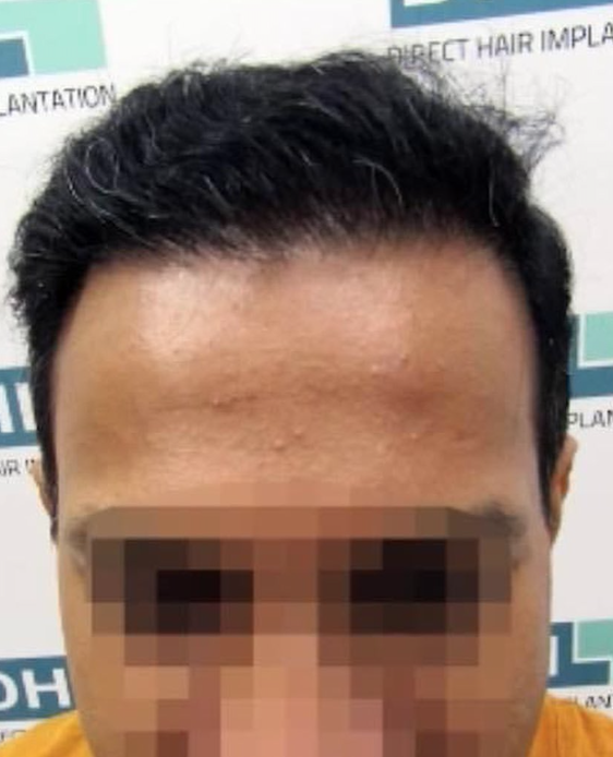 12 MONTHS POST-OP DHI hair transplant