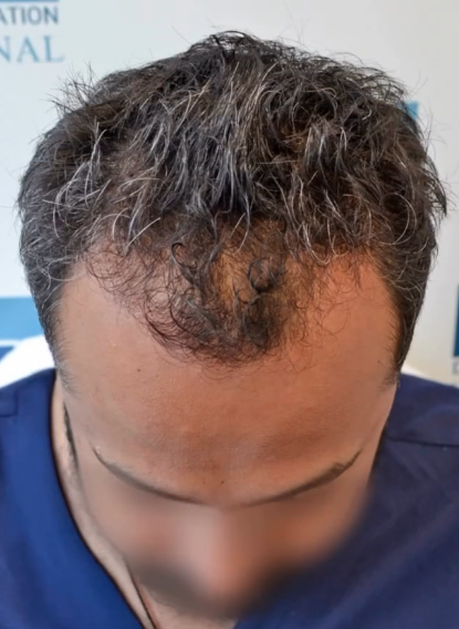 DAY 1 DHI hair transplant