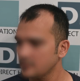 DAY 1 DHI hair transplant