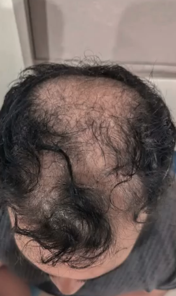 DAY 1 DHI hair transplant