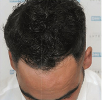 12 MONTHS POST-OP DHI hair transplant