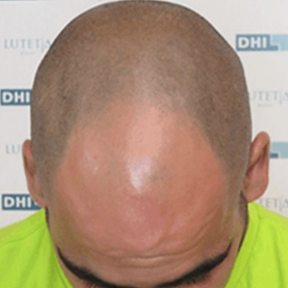 DAY 1 DHI hair transplant