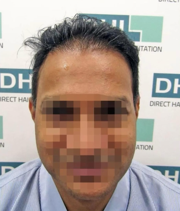DAY 1 DHI hair transplant