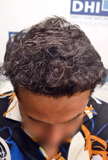 12 MONTHS POST-OP DHI hair transplant