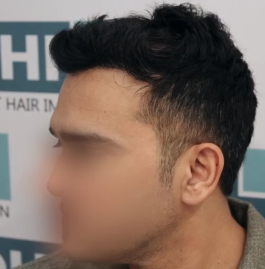 12 MONTHS POST-OP DHI hair transplant