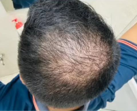 DAY 1 DHI hair transplant