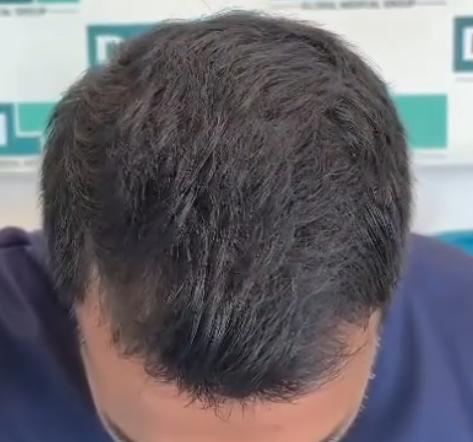 12 MONTHS POST-OP DHI hair transplant