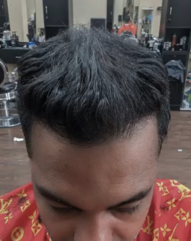 12 MONTHS POST-OP DHI hair transplant